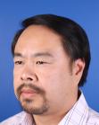 After Hair Transplant&nbsp;Front